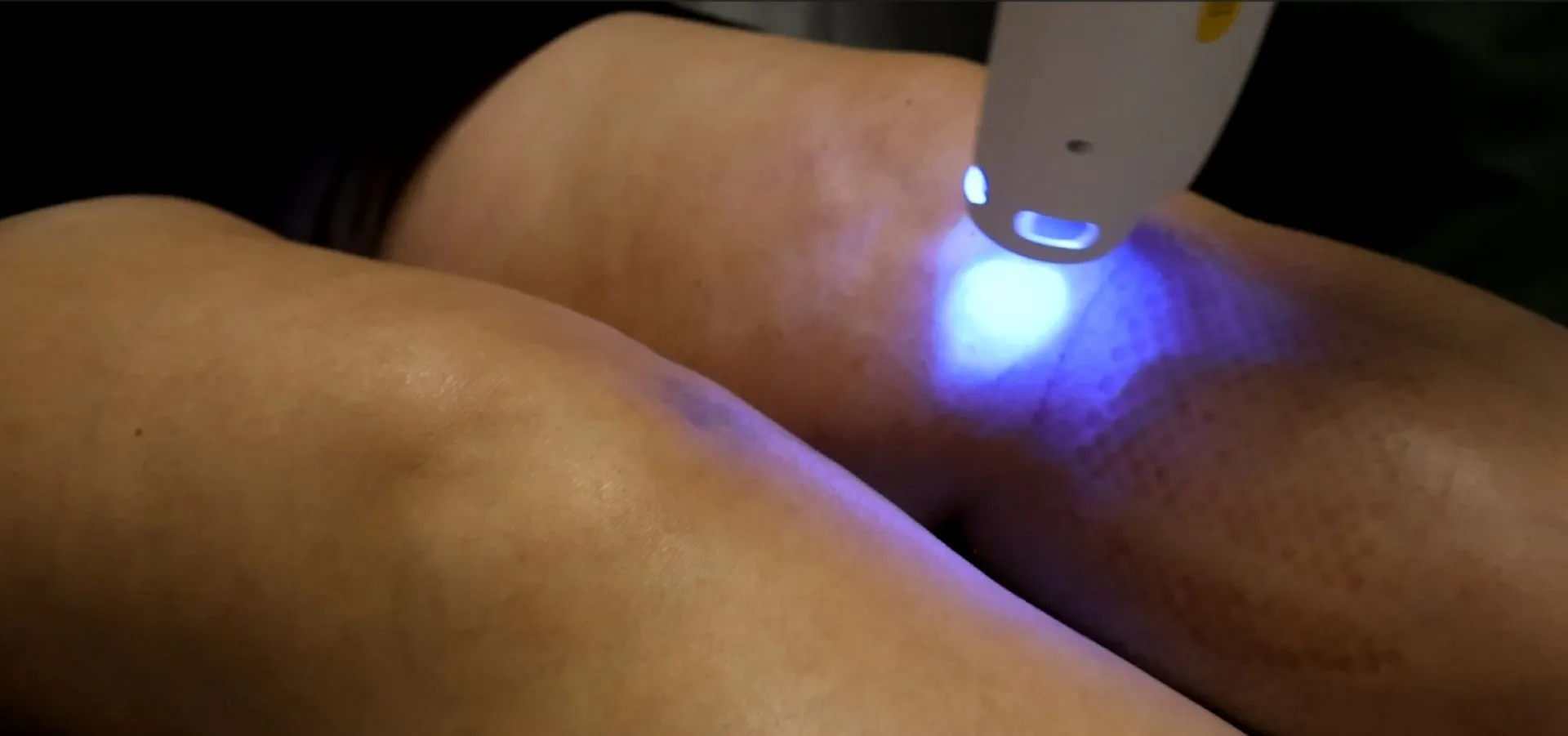 Cryotherapy for Knee Pain: How Cold Therapy Reduces Swelling