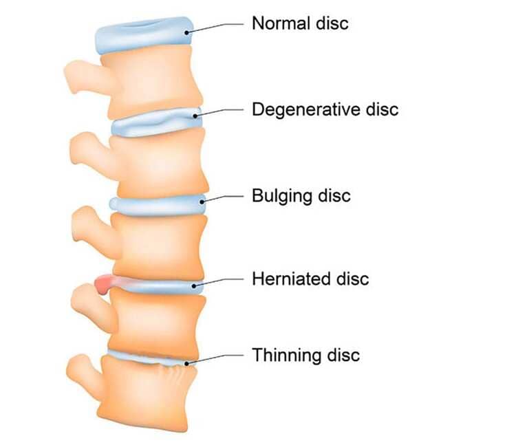 Degenerative Disk Disease