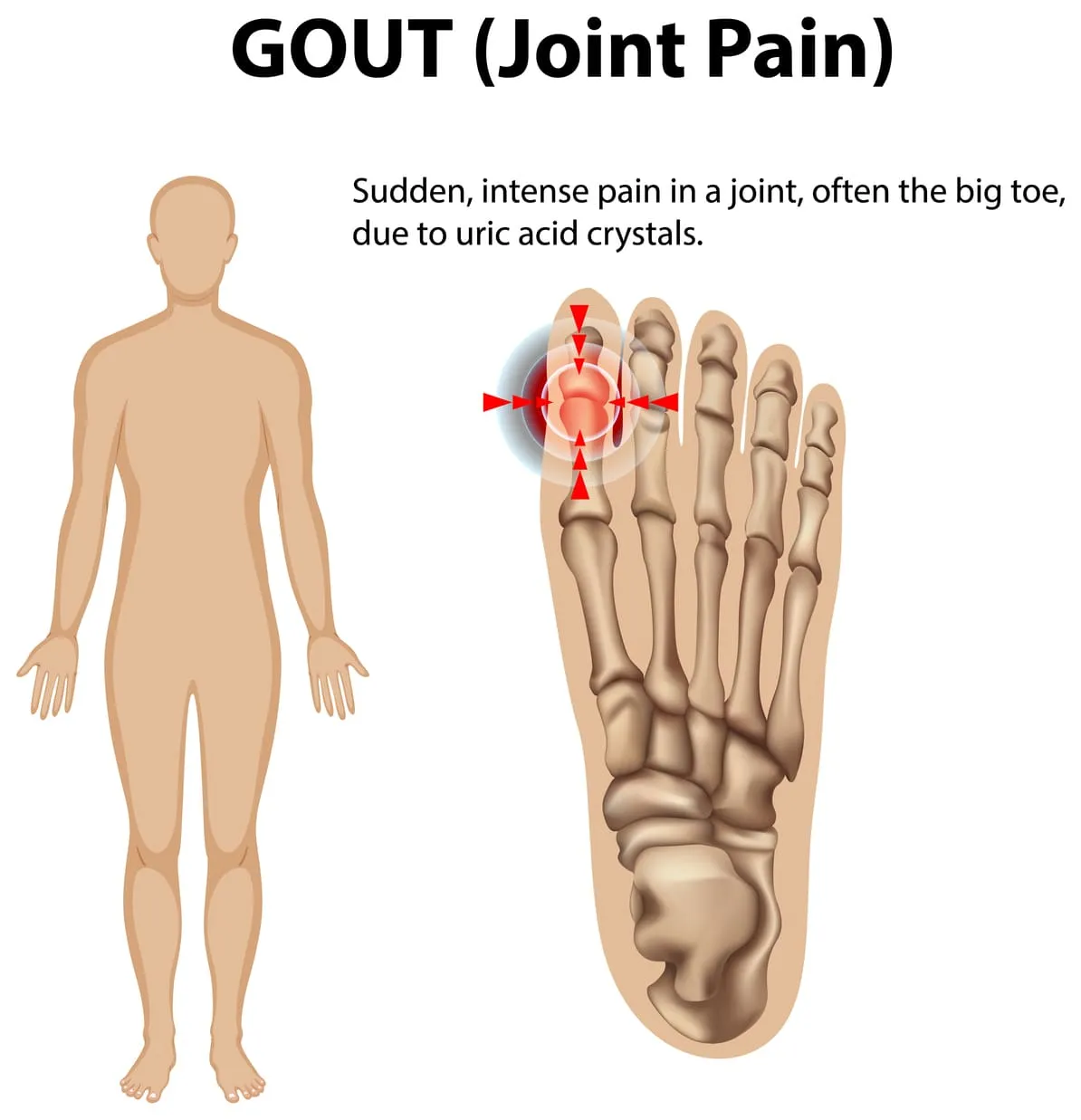 Gout Treatment in Richmond Hill: Symptoms, Causes