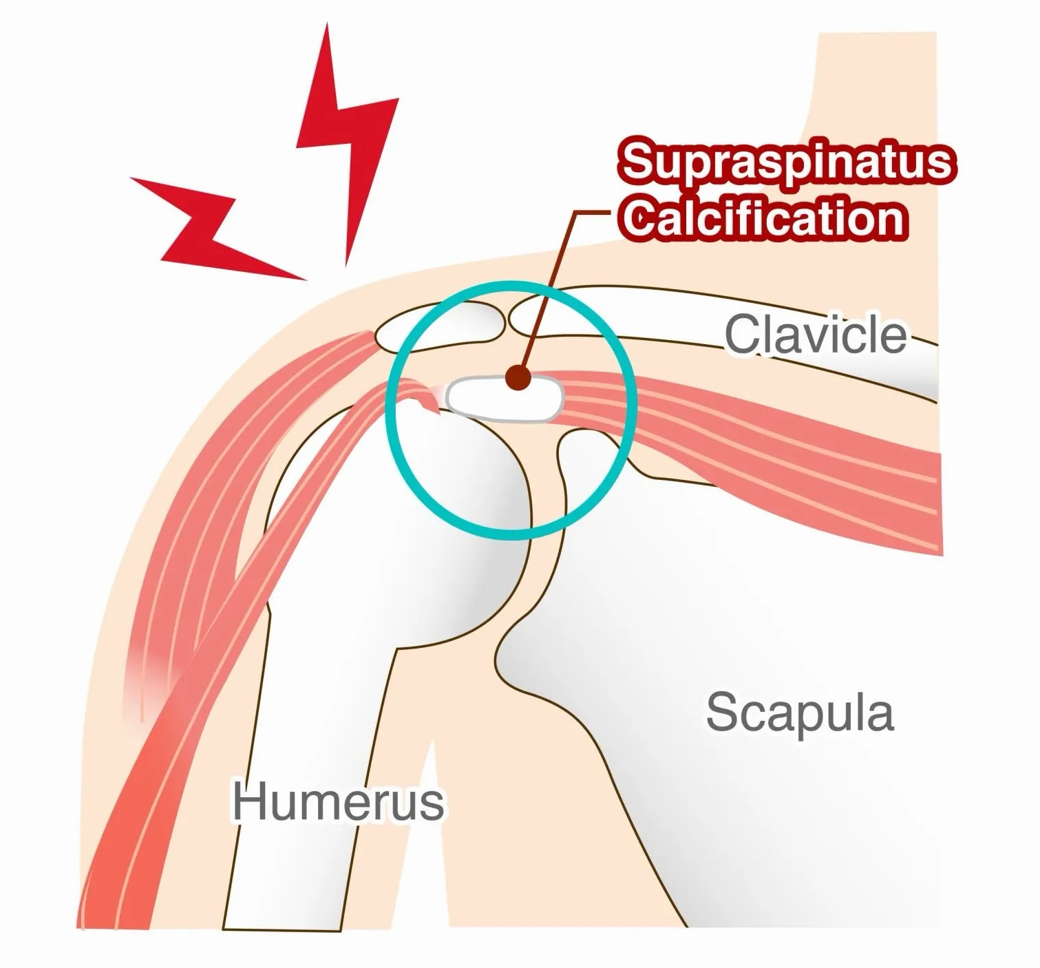 Breaking Down Chronic Pain: How Focused Shockwave Therapy Treats Calcific Tendonitis in Richmond Hill