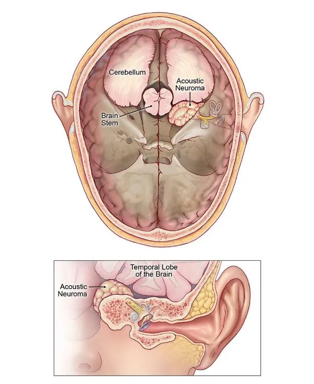 Rehabilitation after Acoustic Neuroma Surgery