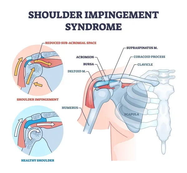 Shoulder Impingement: Causes, Symptoms and Treatment