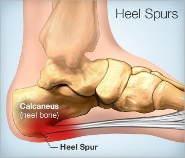  heel spur Treatment in Richmond Hill