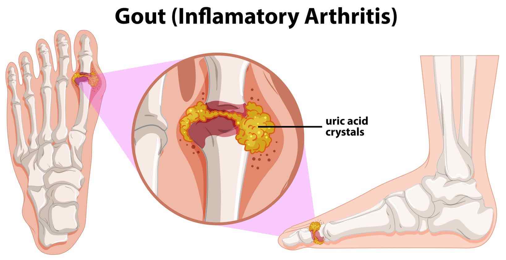 Gout Treatment in Richmond Hill