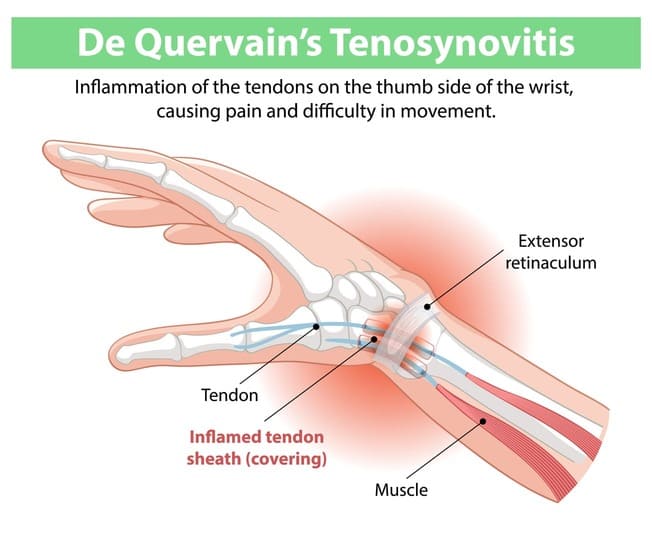 De Quervain’s Syndrome Treatment in Richmond Hill