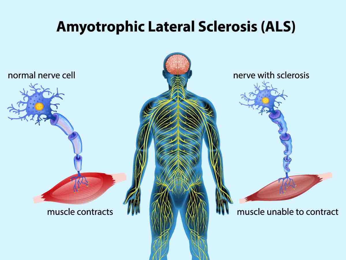 Amyotrophic Lateral Sclerosis - ALS