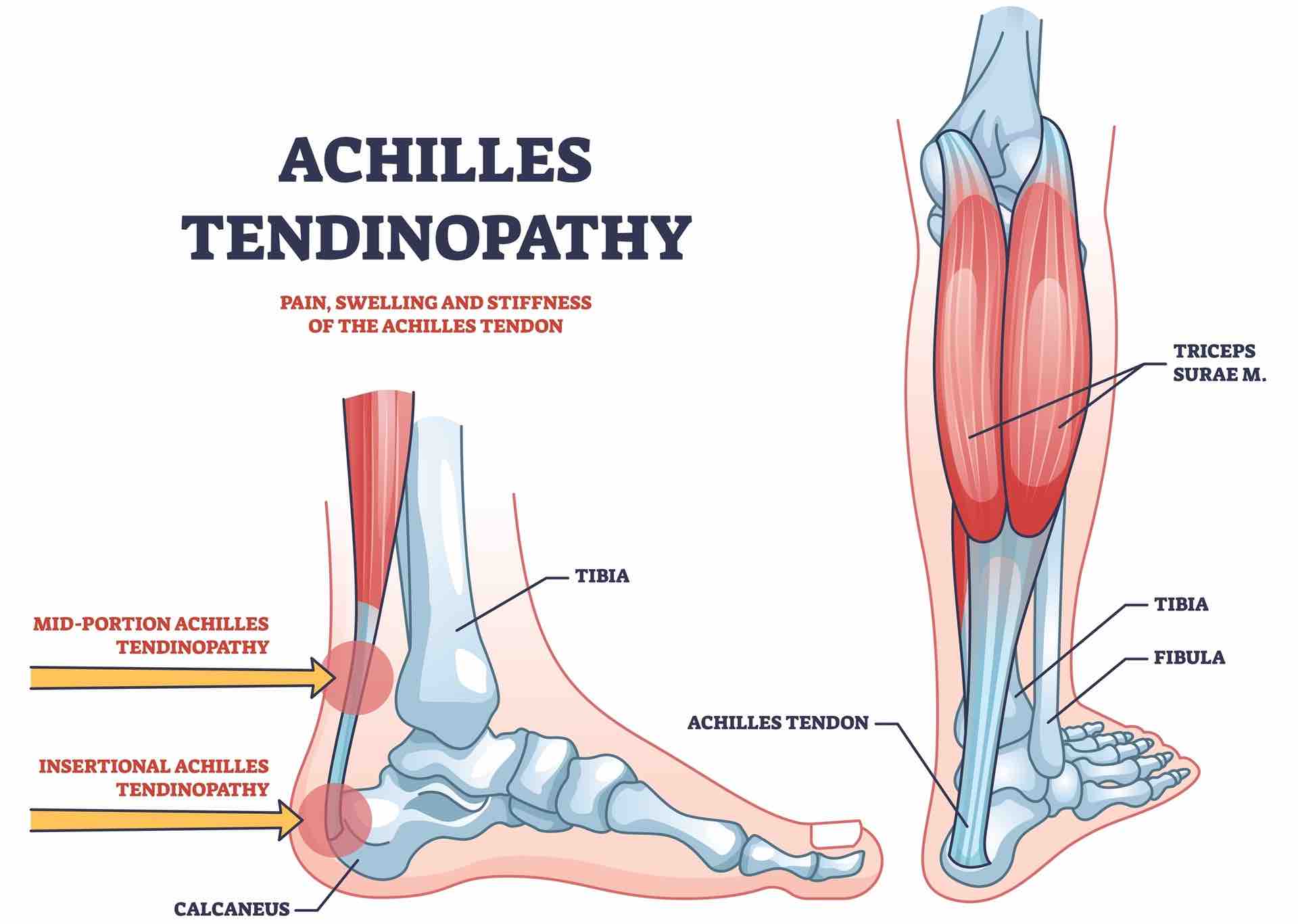 Achilles tendinitis injury 