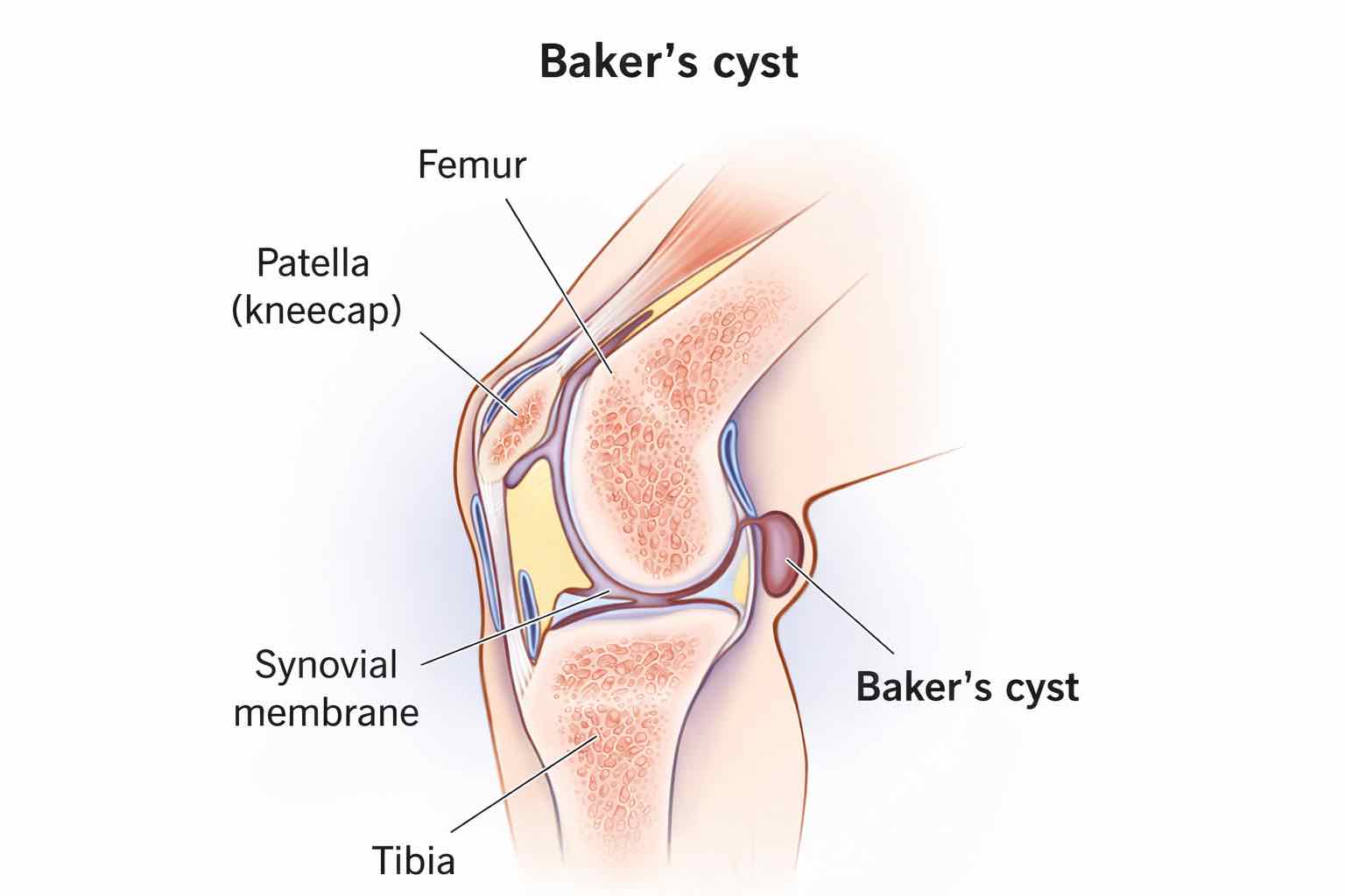 Baker’s Cyst Treatment