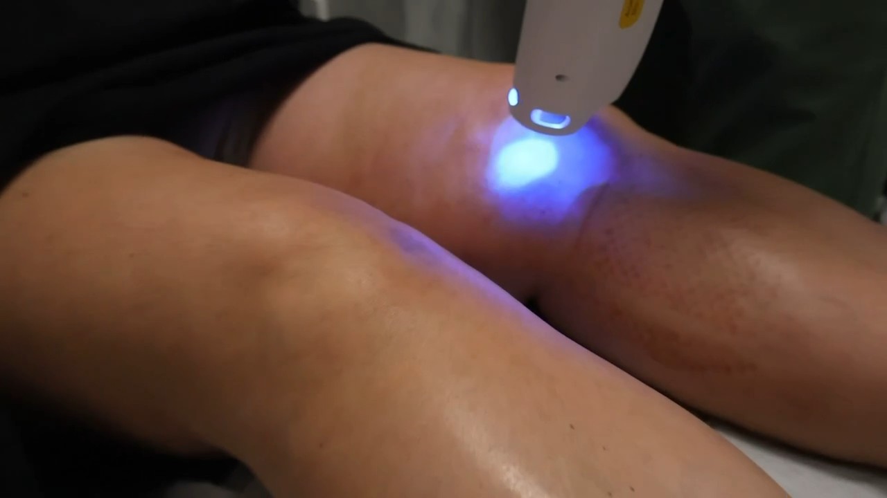Cryotherapy treatments in Richmond Hill