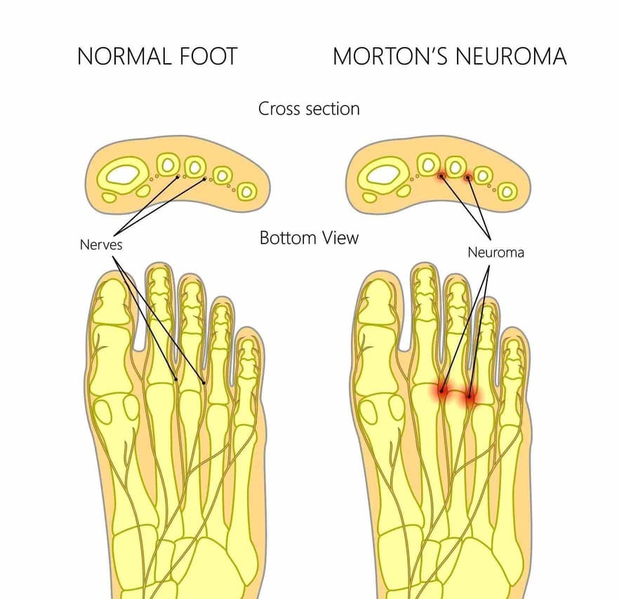 Morton’s Neuroma treatment in Richmond Hill