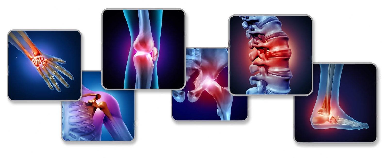 Fibromyalgia