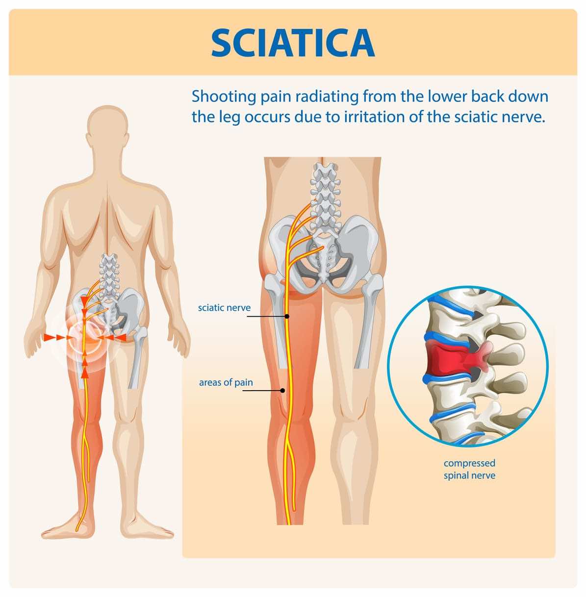 Common Causes Of Sciatica And How Physiotherapy In Richmond Hill Can Help