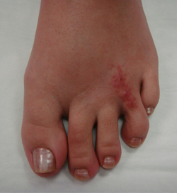 ball of foot