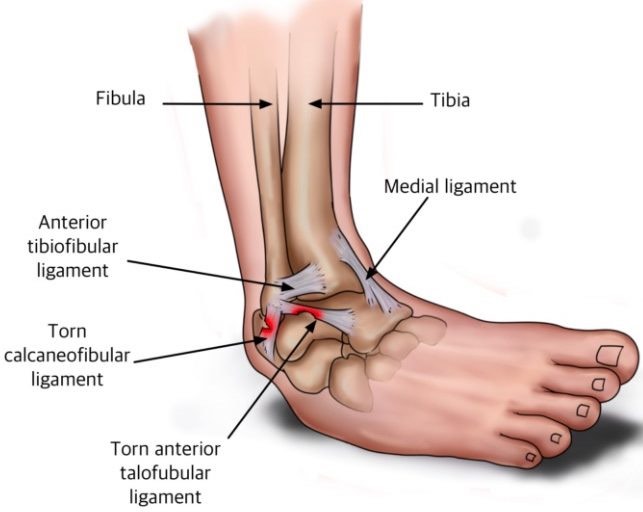 Ankle Injuries in Sports | Treatments