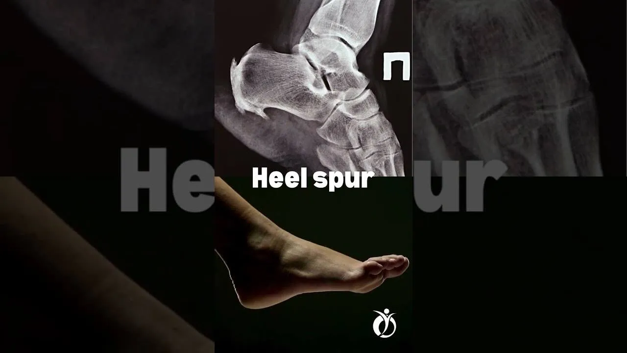 Best Heel Pain & Heel Spur Treatments in Richmond Hill