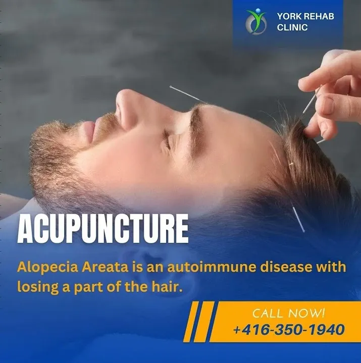 Hair loss - Alopecia Treatment in Richmond Hill