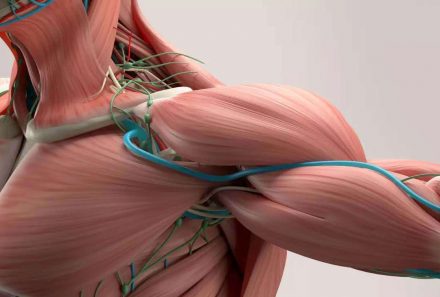 What is thoracic outlet syndrome?